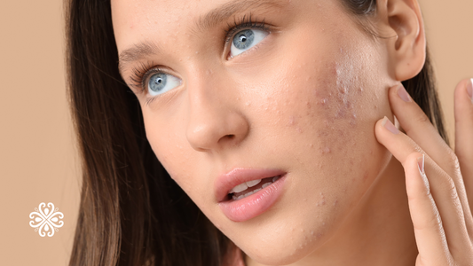 The Best Makeup for Acne-Prone Skin in Australia (That Won't Make It Worse)
