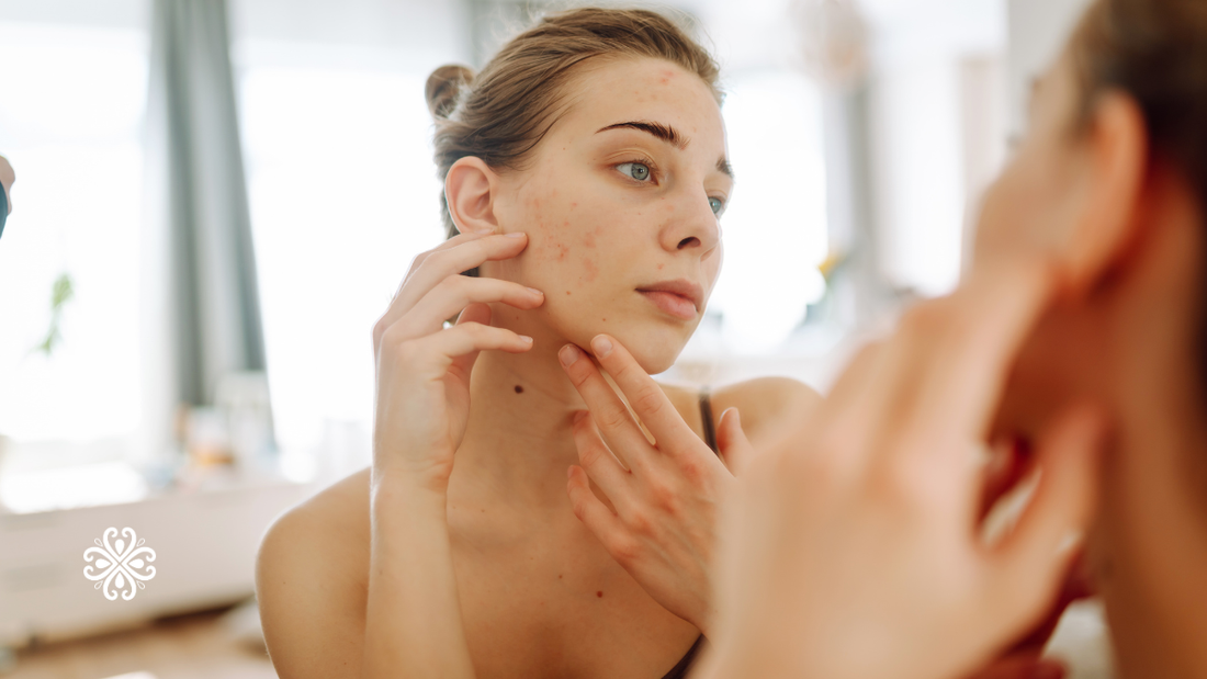 Makeup for Psoriasis: Gentle Options That Cover Without Flaring