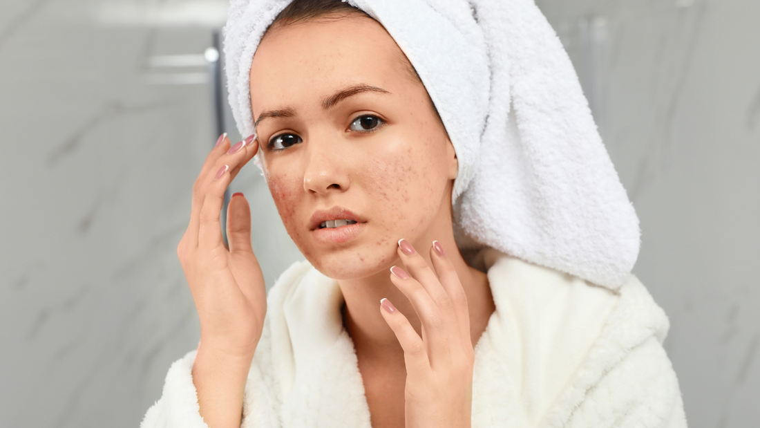 Mineral Makeup Benefits | Acne-Prone skin | Alluring Minerals