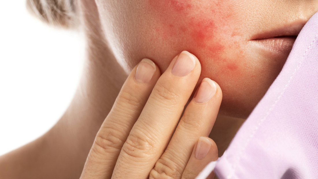 The Radiant Solution: Exploring the Benefits of Mineral Makeup for Rosacea - Alluring Minerals